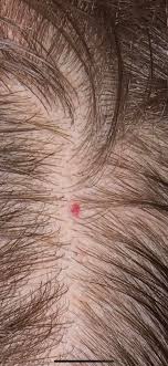 Am I Developing Developing Ringworm On My Scalp I Had Ringworm On My Body For About 3 4 Months It Finally Healed Healed A Few Weeks Ago However Now I Noticed This Dot Ringworm of the scalp, also known as tinea capitis, is a fungal infection. am i developing developing ringworm on