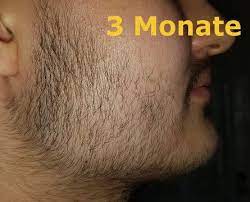 Der bart ist eines der sekundären geschlechtsmerkmale des mannes und wächst an wangen, kinn und um den mundbereich. á…á… Minoxidil Bart Erfahrung Der Langzeit Test Monatliche Bilder