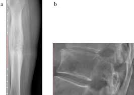 Morgan department of radiology & radiological science, the johns hopkins. Deep Learning Based Classification Of Primary Bone Tumors On Radiographs A Preliminary Study Ebiomedicine