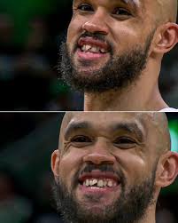 Should NBA players be mandated to wear mouthguards?