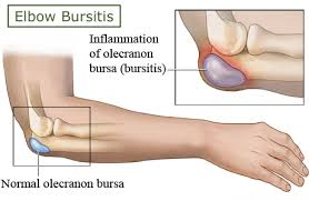 In 1993, labelle et al. Elbow Pain Can Be Caused By Arthritis Tendonitis Etc Elbow Pain Treatments