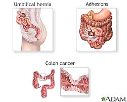 Image result for Intestinal Obstruction