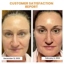 Oveallgo™ Koreyen Pwofesyonèl Dermalayr Teknoloji Soluble Collagen Film