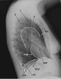 Image result for Chest XRay Interpretation