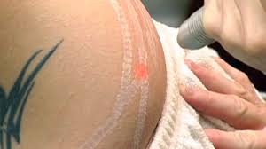 Laser Stretch Mark Removal Get Rid Of Stretch Marks Laser Stretch Mark Removal Stretch Marks Stretch Mark Removal