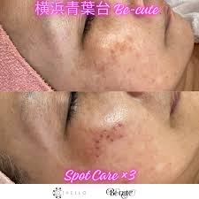 シミケアオセロ | 横浜青葉台シミ毛穴たるみ改善専門のエステ美キュート
