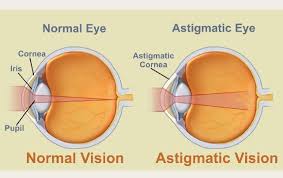 Image result for Refractive Error