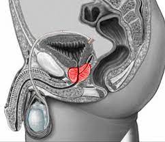cancer today data showed that pca was the second most frequently diagnosed cancer and the fifth leading cause of cancer mortality among men worldwide in 2012. Figure The Prostate Gland Image Courtesy S Bhimji Md Statpearls Ncbi Bookshelf