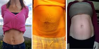 Du behøver ikke å bekymre deg for at babyen skal syntes det er skummelt. Fodsel Mage Sa Forskjellig Kan Magen Se Ut Etter Fodsel