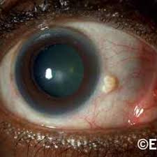 Image result for lesion sclera