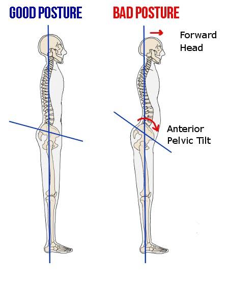 Anterior pelvic tilt?