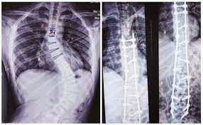 Asiri Central S Brain Spine Neurosurgical Team Performs First Ever Life Changing Scoliosis Surgery Asiri Health