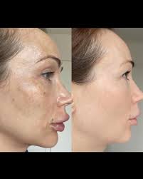 This treatment is just that good!! 🫧 The Cosmelan Depigmentation Peel is a  type of chemical peel that's designed to improve skin hyperpigmentation,  skin discoloration, scarring, and uneven skin texture. Who's a