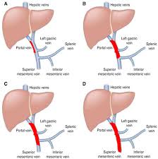 Cirrhosis poses a difficult challenge for management, while the disease's prevention, detection, and therapy engender. Clinical Liver Disease Wiley Online Library