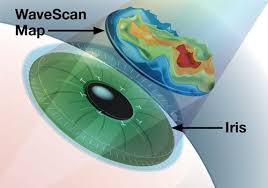 Kisiye Ozel Laser Goz Tedavisi Yontemi Wavefront Dalga Cephesi Rehberli Lasik Dalga Cephesi Analizi Gozde Aberrasyon Denen Ve Gorme Kali Dalga Ikiz Lime