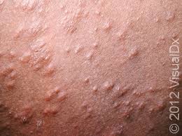Image result for sweat rash on back