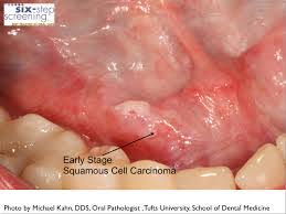 This type of skin cancer is also usually seen in areas of the body that get a lot of sun, although it can be found in other areas as well. Oral Cancer Screening From Milton Keynes Dentist