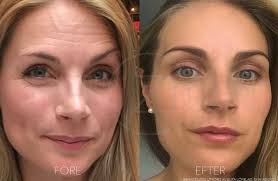 Du kommer att uppleva en kortare. Fuktbehandling Ansikt