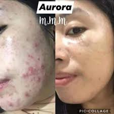 San mga nagha2nap ng skin pure skin no fats meron na po ulit