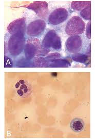 Eventually you might not have enough healthy bone marrow to make blood cells. Trastuzumab Monotherapy For Bone Marrow Metastasis Of Breast Cancer A Case Report