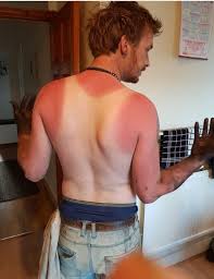 Uk Weather Has Thousands Of Pale Brits Complaining About Sunburn As Heatwave Scorches The Nation And There S More To Come