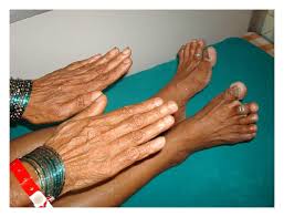 Image result for Clubbing nails feet