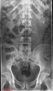 Image result for Nephrolithiasis Imaging