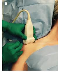 Image result for Subacromial Space Injection