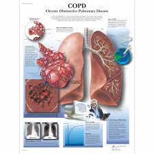 The problem is determining whether these medications are ultimately helpful. Copd Chart Chronic Obstructive Pulmonary Disease 1001522 3b Scientific Vr1329l Charts And Posters About The Respiratory System