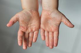 About Hand Foot And Mouth Disease Bard Didriksen Pediatrics