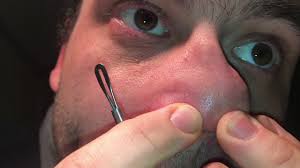 Wir erklären ihnen, wie sie diese unreinheit möglichst schnell wieder loswerden können und wie es überhaupt zur entstehung von pickeln auf der lippe kommt. Mitesser Komedonen Blackhead Entfernen Mit Komedonenheber Komedonenquetscher Anleitung Youtube