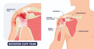 Image result for Rotator Cuff Rupture