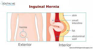 Inguinal Hernia- Causes, Types, Symptoms, Diagnose & Treatment | Texas