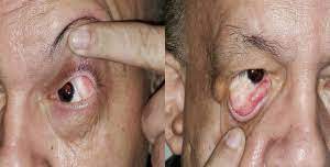 Goldenhar Syndrome Eyewiki