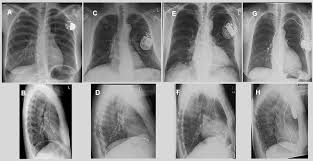 Aug 21, 2018 · röntgen des knochensystems zur diagnose von knochenbrüchen, verschleiß, entzündungen und verletzung von gelenken, sehnen oder bändern röntgenuntersuchungen des kopfes zur feststellung von schädelbrüchen und entzündungen der nasennebenhöhlen. Https Www Thieme Connect Com Products Ejournals Pdf 10 1055 S 0034 1369088 Pdf
