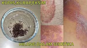 Nama obat gatal pada kulit di apotik umum kimia farma dan k24 ~ banyaknya merek obat untuk penyakit eksim yang kini tersebar atau tersedia di apotik mungkin membuat para penderita penyakit eksim atau gatal kini merasa bingung untuk memilih obat mana yang baik atau bagus untuk di gunakan sebagai perantara penyembuh penyakit eksim yang mereka derita. Krim Obat Gatal Eksim Yang Paling Ampuh Di Apotik Article Articleted News And Articles