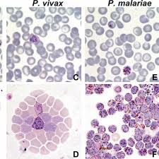 It is transmitted by the female anopheles mosquito. Malaria Mdm Concentrates Plasmodium Infected Erythrocytes P Download Scientific Diagram