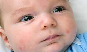 Don't pinch or scrub the acne. Baby Acne Causes And Treatment Pampers
