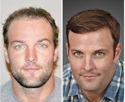 Wes welker and the science of hair transplants. Welker Pretrazi Twitter