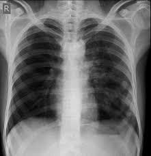 Check spelling or type a new query. Pulmonary Tuberculosis Radiology Case Radiopaedia Org