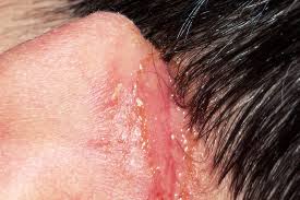 Image result for yellow scabs on the face in children
