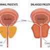 For some men, genetic factors may put them at higher risk of prostate cancer. 1