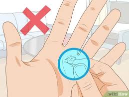 Plus, it is also abundant in the acetic acid that is perfect for quickening your recovery from the blood blisters. 5 Ways To Treat A Blood Blister Wikihow