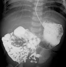 Image result for Intestinal Malrotation