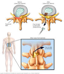 Maybe you would like to learn more about one of these? Herniated Disk Diagnosis And Treatment Mayo Clinic