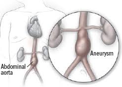 The aorta is the largest. Abdominal Aortic Aneurysm Harvard Health