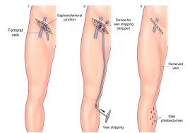 Varicose vein surgery