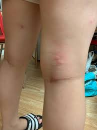 Image result for bedbugs bites