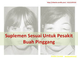 Untuk meredakan rasa nyeri akibat sakit pinggang, simak rekomendasi merk obat sakit pinggang paling ampuh yang bisa kamu temukan di apotik dan umum digunakan mau minum susu kambing dengan rasa enak dan pasti kaya vitamin yang baik untuk tubuh kamu? Nutrisi Sesuai Untuk Pesakit Buah Pinggang Vitamin Cerdik By Coach Anah Ahmad