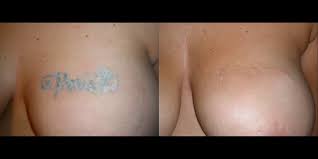 It is the procedure of removing a tattoo by actually cutting it out. Abdominoplasty